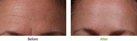 SilcSkinBeforeAfter-Anim-
