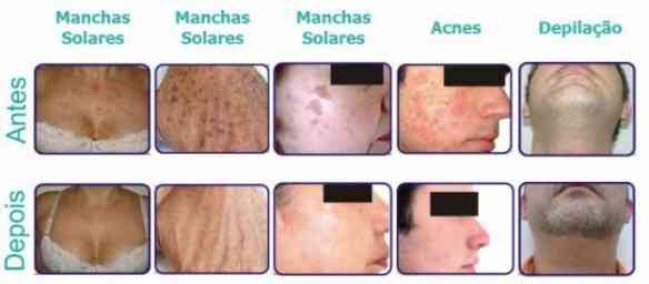 1334697130_354477422_2-LPI-Luz-Pulsada-Intensa-BIOFLASH-IPL-SYSTEM-Depilacao-Fotodepilacaomodernoo-q-o-LASER-Conselheiro-Lafaiete