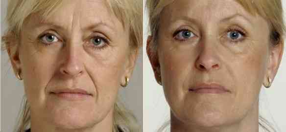Facial-fillers-restylane1