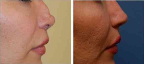 NonSurgical1