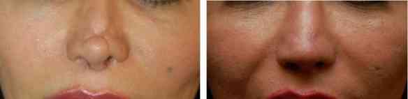 NonSurgical3