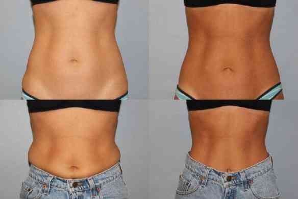 coolsculpting