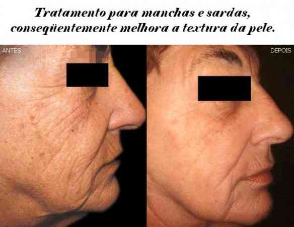 manchaerejuvencLIP