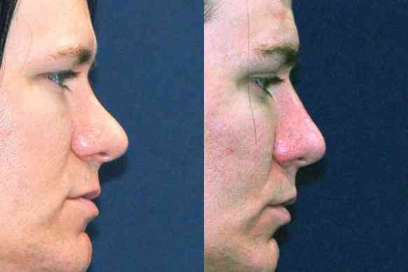 non_surgical_nose_job_los_angeles_non_surgical_nose_job_with_fillers_01