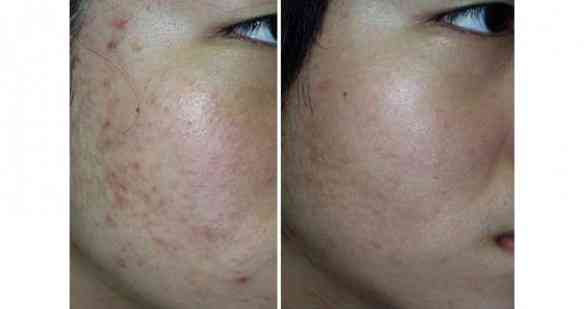 Acne-using-Photodynamic-(PDT)-Therapy-before-and-after-2_l