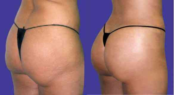 butt-lift-case-3-before-after