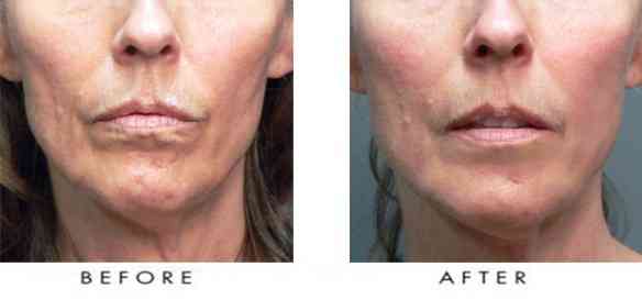 Sculptra-Face-Filler