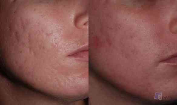 Acne-Scarring_1