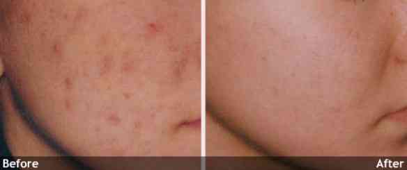 Acne-Scars-Angle
