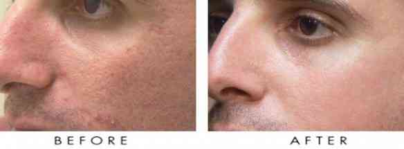 LaserResurfacing1