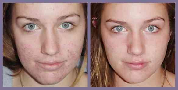 acne-scars
