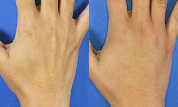 restylane-hands-ba-1400px