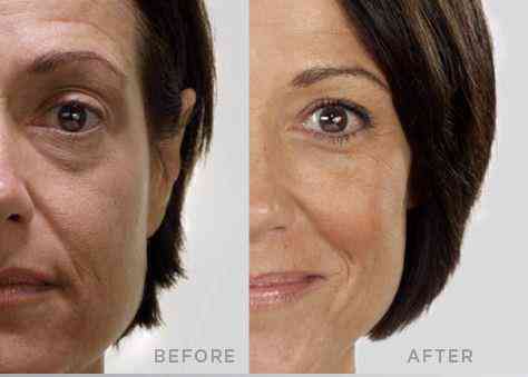 Jeunesse Before_After